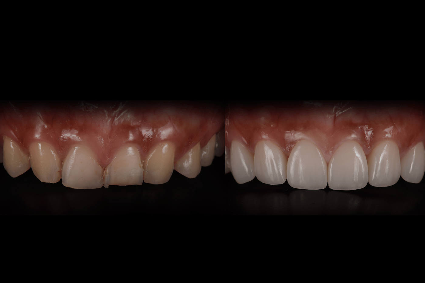 Full Mouth Reconstruction